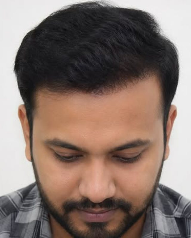 How Much Does a Hair Transplant Cost in Dubai?