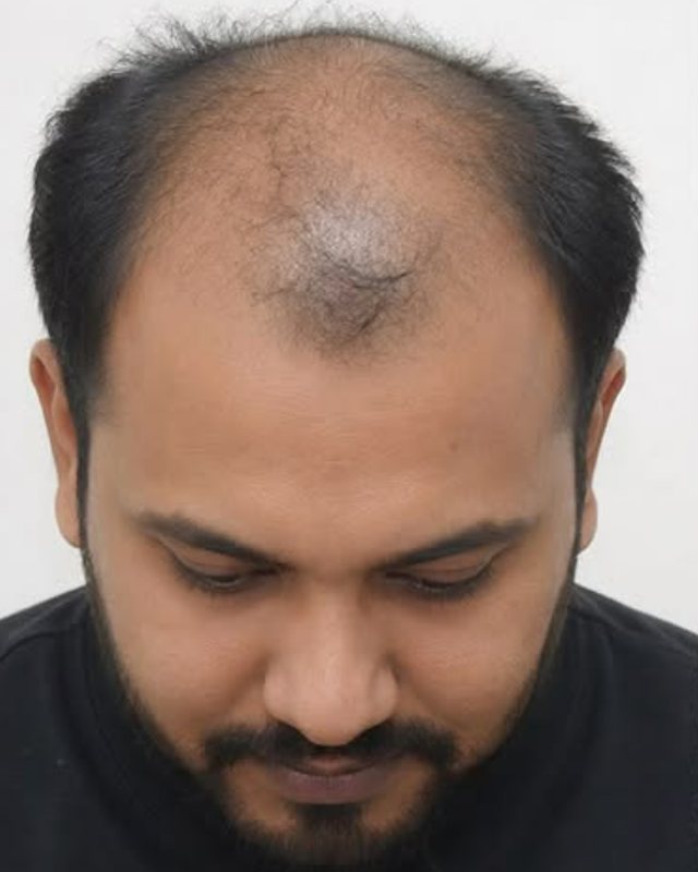 Before, Hair Transplant before and after result