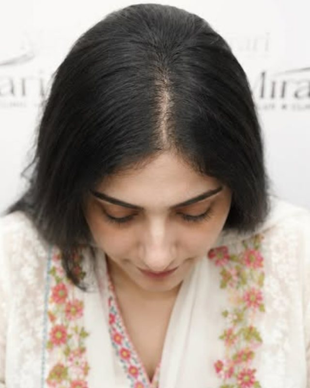 PRP After a Hair Transplant: Is It Helpful?