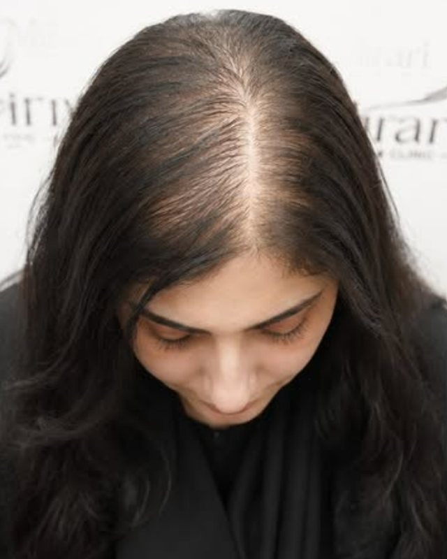 Before, Female Hair Restoration before and after result