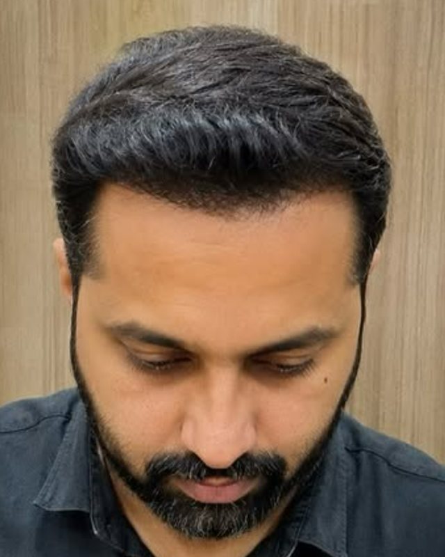 When Will I See Hair Transplant Results?