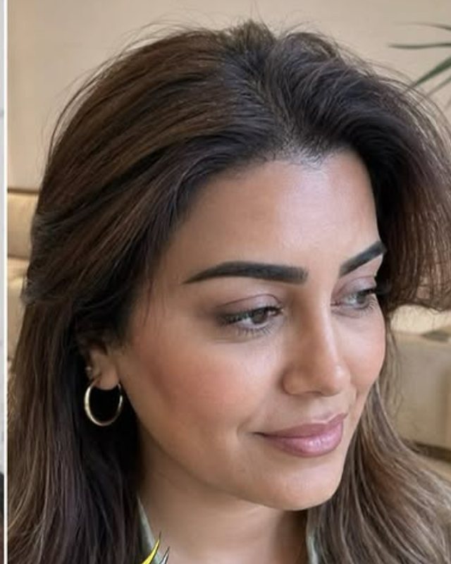 After, Hairline Correction before and after result