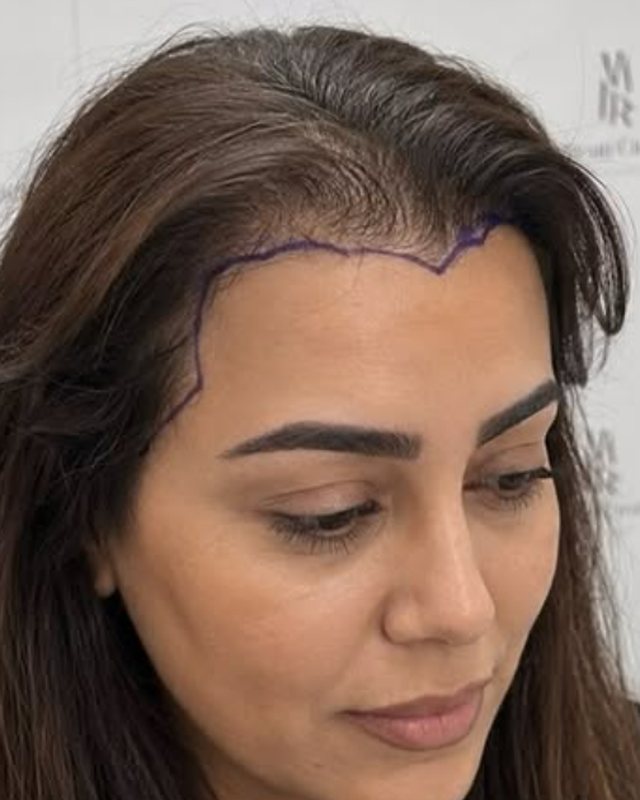 Before, Hairline Correction before and after result
