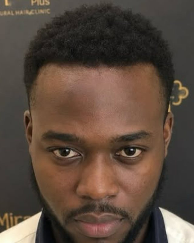 After, DHI Hair Transplant before and after result
