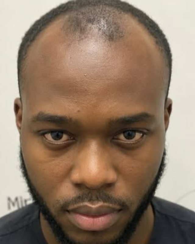Before, DHI Hair Transplant before and after result