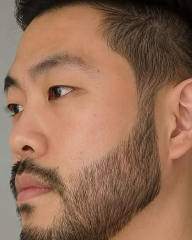Beard Transplant: A Complete Guide