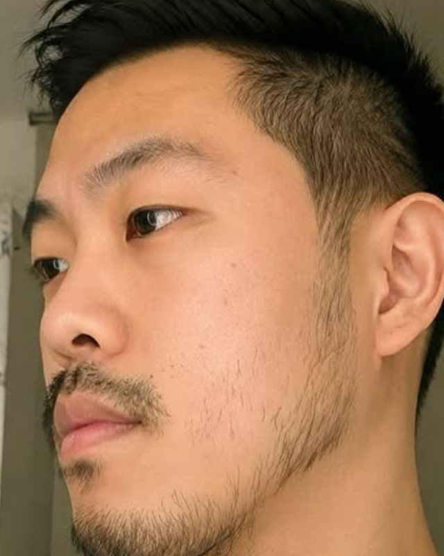 Before, Beard Transplant before and after result