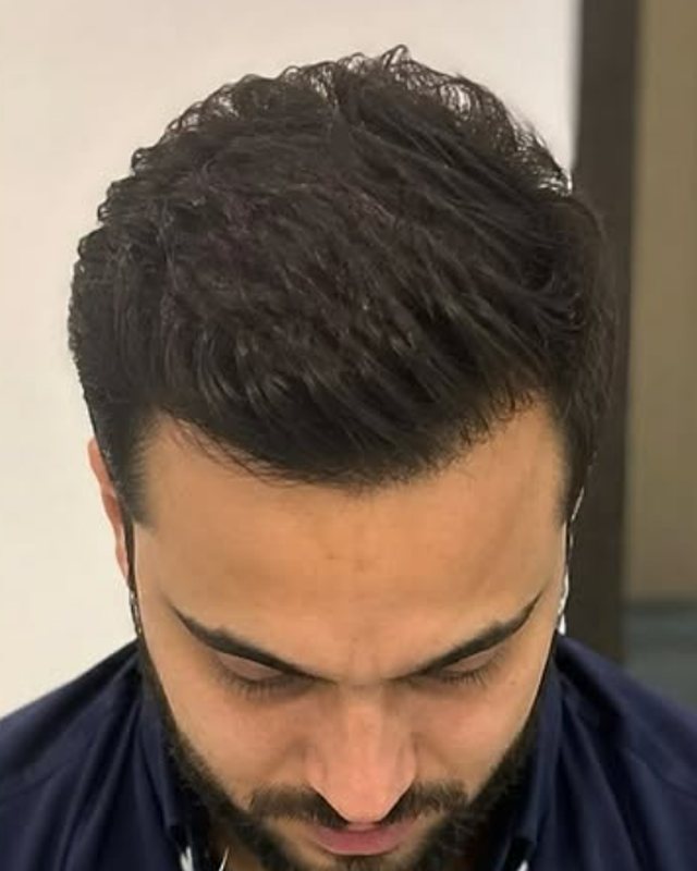 FUE vs DHI Hair Transplant: Which Is Better?