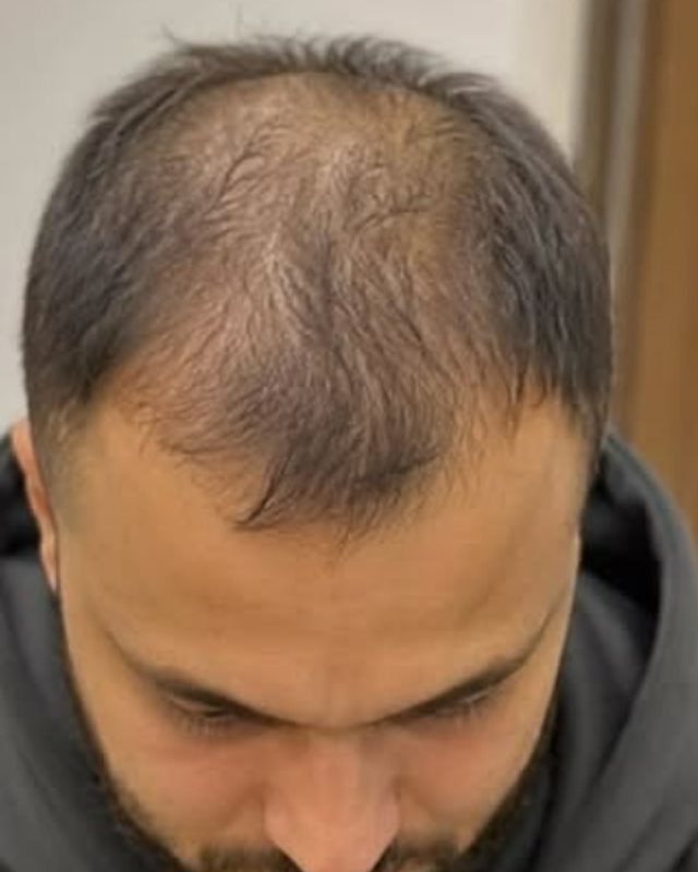 Before, Crown and mid-scalp restoration